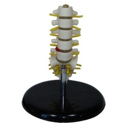 Half-size lumbar vertebrae with sacrum & coccyx and herniated di